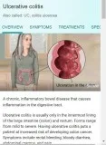 Ulcerative Colitis (UC) Paid Clinical Trial