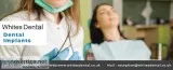 Dental Implants Near Me London SE1 8ER