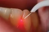 Best Dental implant in Jaipur