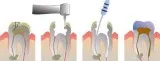 Root Canal Treatment in Noida at City dental Centre