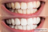 Teeth Cleaning In Griffin