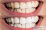 Teeth Cleaning In Griffin