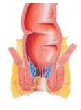 Find Hemorrhoid Treatment That Actually Works