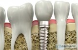 Choose the Medical Facilitators For Dental Implants in Cancun