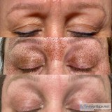 Eyelift fibroblast plasma pen