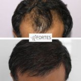 Hair transplant specialist in london