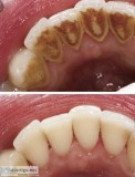 Dental cleaning