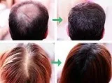 Hair Loss Medication - Revive Hair and Skin Clinic