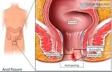 Best doctor for fissure in bhandup, vikhroli & mulund