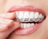 Invisalign Auckland