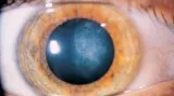 BEST CATARACT SURGERY EYE HOSPITAL IN CHENNAI