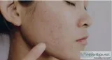 Result-oriented Acne Scar Treatment in chennai at Tamira Medical