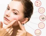 Acne Marks Treatment