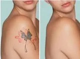 Laser tattoo removal in mumbai