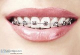 Colored braces in Nagpur