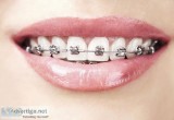 Colored braces in Nagpur