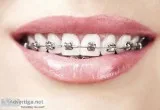 Colored braces in Nagpur