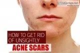How to remove acne scars fast | ayurvidha