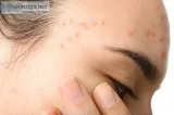 Best ayurvedic cream for acne | ayurvidha