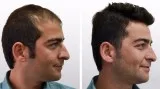 Get the best hair loss treatment in delhi
