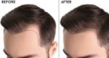 Get the best hair patch in gurgaon at affordable price