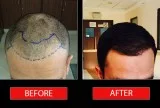 Get the best hair transplant in chennai at ahs