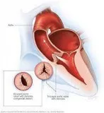 Heart valve replacement