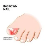 Ingrown Toenail Remedies And Causes