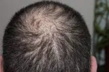 Best baldness treatment from advanced hair studio