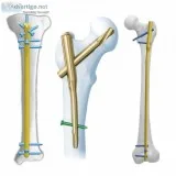 Orthopedic products manufacturers in india
