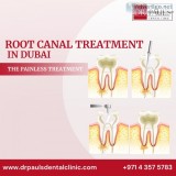 Root canal treatment in dubai
