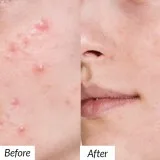 Scar removal treatment