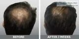 Hair fall treatment in chennai