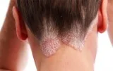 Best doctor for psoriasis treatment in delhi