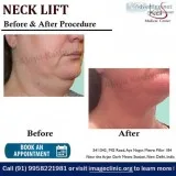 Low Cost Neck Lift Cosmetic Surgery Clinic in Delhi