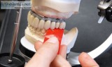 Teeth filling in coimbatore
