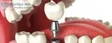 Best root canal clinic in coimbatore