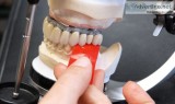 Dentures specialist in coimbatore