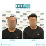Hair transplant cost in bangalore - dhi india