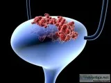 Bcg bladder cancer treatment cost in coimbatore