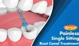 Single Sitting Root Canal Treatment