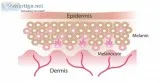 Birthmark treatment in delhi