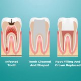 Laser root canal treatment in delhi| root canal treatment (rct)-