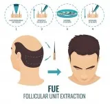 Hair transplant surgery in delhi | recon