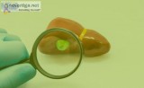 Gallbladder cancer treatment doctor in mumbai