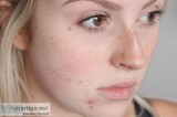 Best acne treatment in delhi, india