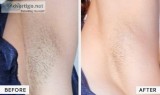 Best laser hair removal treatment in noida