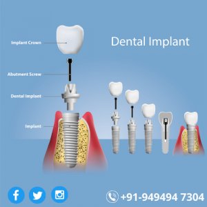 Implant Surgical Procedure