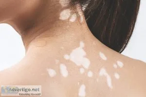 Get treatment for vitiligo from the best skin specialist in indi