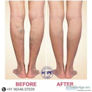 Laser Varicose Veins